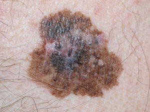 melanoma-2-300