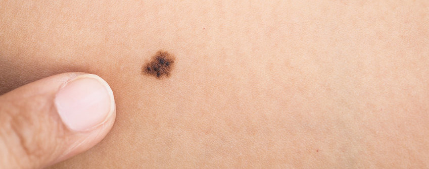 Ingyenes Melanoma Szres
